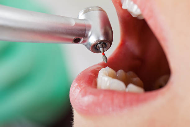 Best Emergency Wisdom Teeth Removal in Cleveland, FL